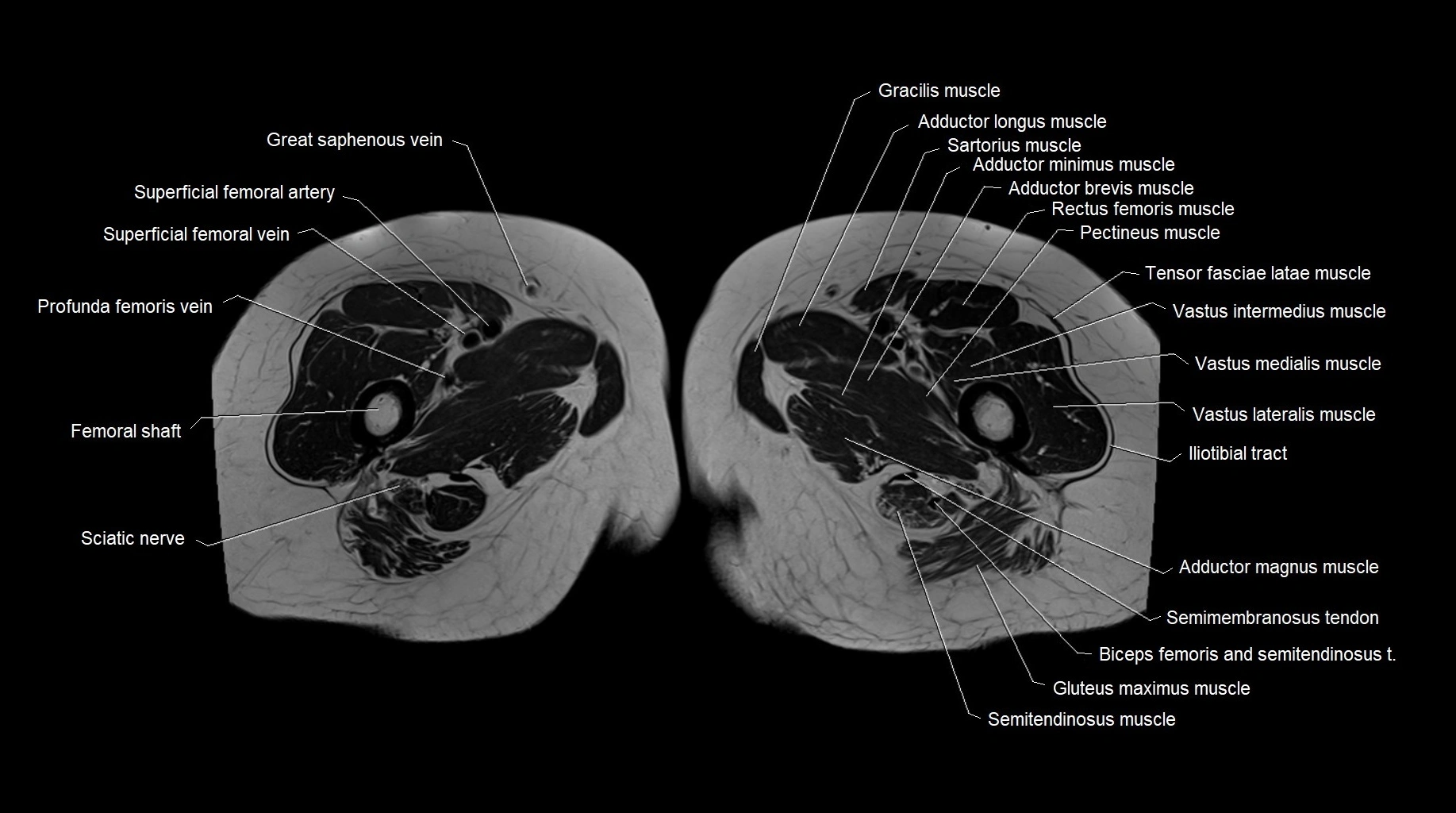 MRI 3T pelvis axial cross section anatomy image 39.webp